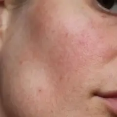 Skóra naczynkowa z zaczerwienieniami. Retinol może pomóc w jej pielęgnacji, wzmacniając barierę ochronną.