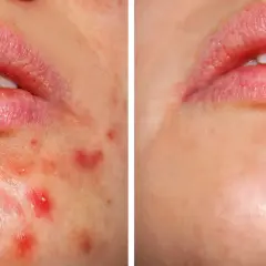 Przed i po: skóra z niedoskonałościami, gdzie kwas salicylowy i retinol pomogły zredukować wypryski.