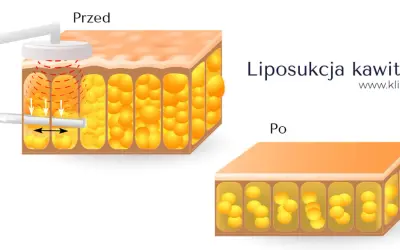 Liposukcja kawitacyjna efekty: przed i po zabiegu. Zmniejszenie ilości komórek tłuszczowych w tkance.