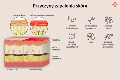 Ilustracja przedstawia przyczyny atopowego zapalenia skóry: czynniki środowiskowe, predyspozycje genetyczne, infekcje, choroby wewnętrzne, stres i kontakt z substancjami drażniącymi.