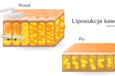 Liposukcja kawitacyjna efekty: przed i po zabiegu. Zmniejszenie ilości komórek tłuszczowych w tkance.