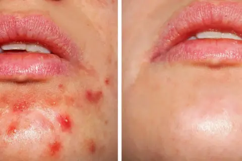 Przed i po: skóra z niedoskonałościami, gdzie kwas salicylowy i retinol pomogły zredukować wypryski.
