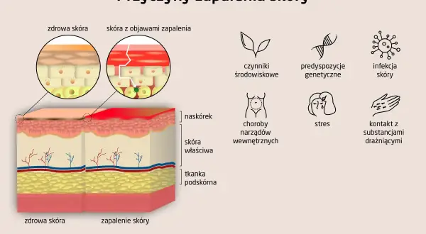 Ilustracja przedstawia przyczyny atopowego zapalenia skóry: czynniki środowiskowe, predyspozycje genetyczne, infekcje, choroby wewnętrzne, stres i kontakt z substancjami drażniącymi.