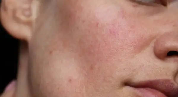 Skóra naczynkowa z zaczerwienieniami. Retinol może pomóc w jej pielęgnacji, wzmacniając barierę ochronną.
