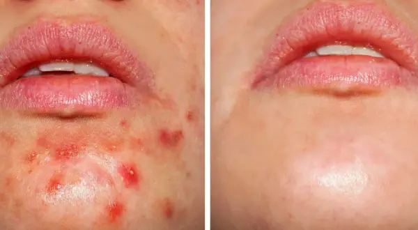 Przed i po: skóra z niedoskonałościami, gdzie kwas salicylowy i retinol pomogły zredukować wypryski.