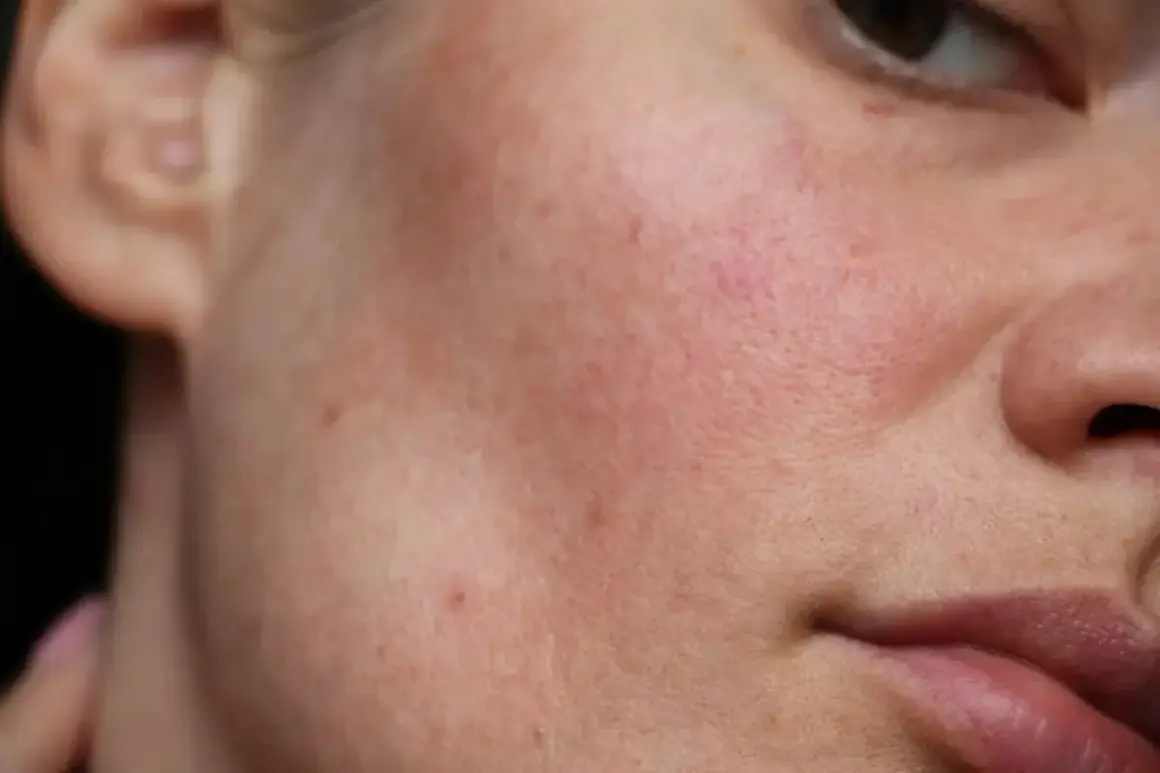 Skóra naczynkowa z zaczerwienieniami. Retinol może pomóc w jej pielęgnacji, wzmacniając barierę ochronną.