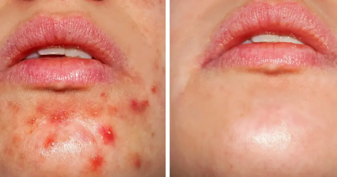 Przed i po: skóra z niedoskonałościami, gdzie kwas salicylowy i retinol pomogły zredukować wypryski.