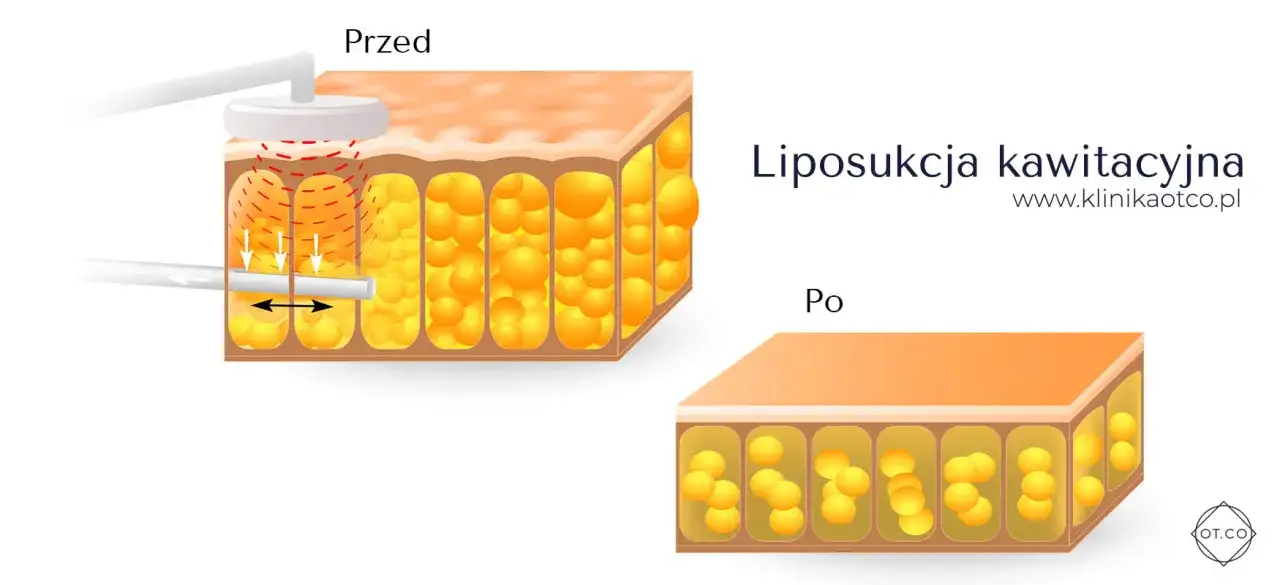 Liposukcja kawitacyjna - efekty, liczba zabiegów i koszty