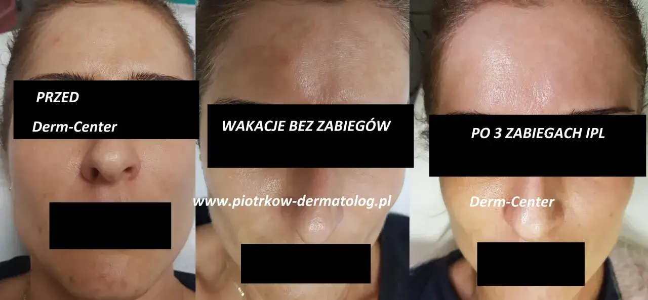 Twarz przed i po zabiegach IPL. Widoczne przebarwienia na twarzy zniknęły po serii zabiegów.