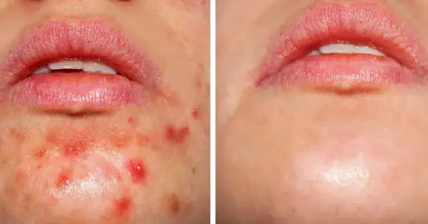 Przed i po: skóra z niedoskonałościami, gdzie kwas salicylowy i retinol pomogły zredukować wypryski.